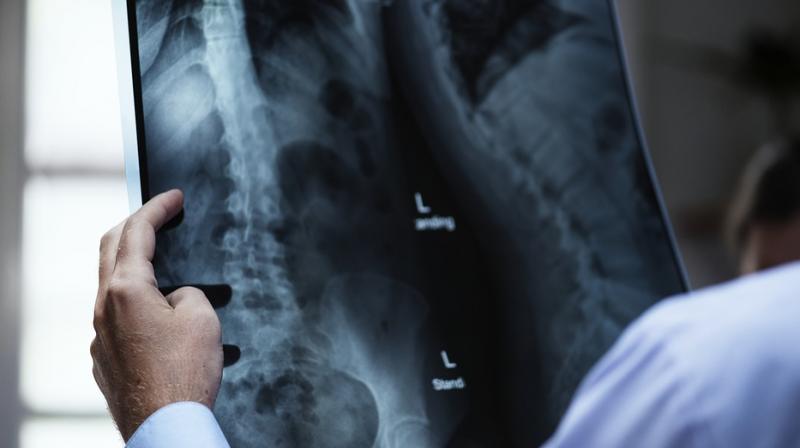 Brittle bone test could prevent hip break agony especially for women, new study finds. (Photo: Pixabay) Brittle bone test could prevent hip break agony especially for women, new study finds. (Photo: Pixabay)