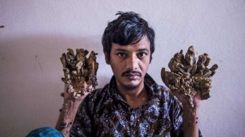 Doctors had believed they had beaten the disease but Bajandar fled a Dhaka clinic in May last year following a relapse. (Photo: AFP) Doctors had believed they had beaten the disease but Bajandar fled a Dhaka clinic in May last year following a relapse. (Photo: AFP)