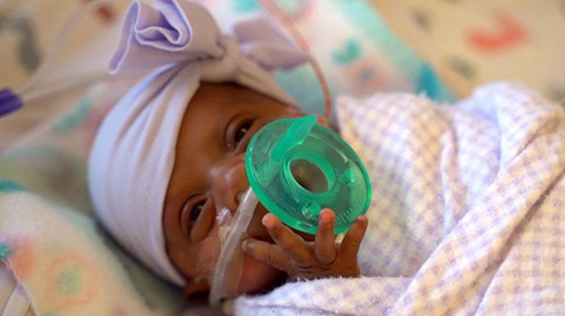 The girl, nicknamed Saybie by hospital staff, was born 23 weeks and three days into her mother’s pregnancy. (Photo: AP) The girl, nicknamed Saybie by hospital staff, was born 23 weeks and three days into her mother’s pregnancy. (Photo: AP)