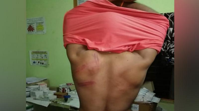 The forest officials suffered bruises after they were attacked on Monday night by tribes with sticks. (Photo: ANI | Twitter) The forest officials suffered bruises after they were attacked on Monday night by tribes with sticks. (Photo: ANI | Twitter)