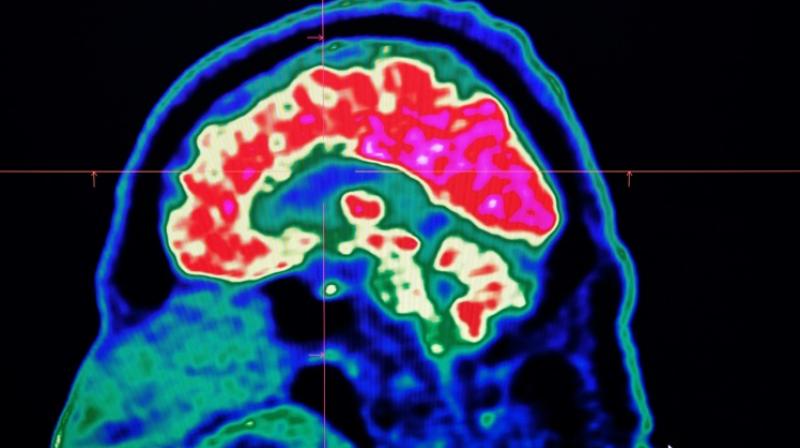 Our brain works like a thermostat when it comes to amplifying or suppressing pain. (Photo: AFP) Our brain works like a thermostat when it comes to amplifying or suppressing pain. (Photo: AFP)