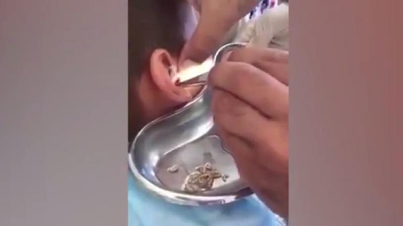 Footage shows doctors removing dozens of maggots which are then wriggling in the stainless steel container (Photo: Youtube) Footage shows doctors removing dozens of maggots which are then wriggling in the stainless steel container (Photo: Youtube)