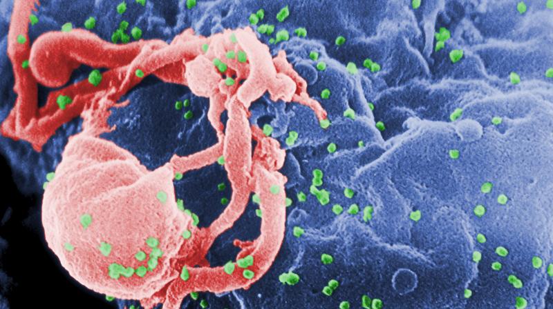 This undated photo provided by the Centers for Disease Control and Prevention shows a scanning electron micrograph of multiple round bumps of the HIV-1 virus on a cell surface. In a report released on Monday, July 24, 2017, researchers said a South African girl born with the AIDS virus has kept her infection suppressed for 8 1/2 years after stopping anti-HIV medicines _ more evidence that early treatment can occasionally cause a long remission that, if it lasts, would be a form of cure. (Cynthia Goldsmith/Centers for Disease Control and Prevention via AP) This undated photo provided by the Centers for Disease Control and Prevention shows a scanning electron micrograph of multiple round bumps of the HIV-1 virus on a cell surface. In a report released on Monday, July 24, 2017, researchers said a South African girl born with the AIDS virus has kept her infection suppressed for 8 1/2 years after stopping anti-HIV medicines _ more evidence that early treatment can occasionally cause a long remission that, if it lasts, would be a form of cure. (Cynthia Goldsmith/Centers for Disease Control and Prevention via AP)