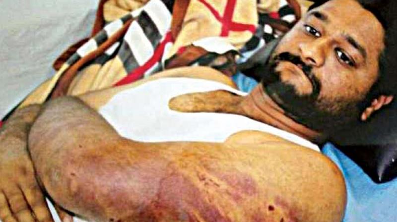 Vivek Shetty who was injured in the alleged attack by the supporters of Kagwad BJP MLA Raju Kage, undergoing treatment Vivek Shetty who was injured in the alleged attack by the supporters of Kagwad BJP MLA Raju Kage, undergoing treatment