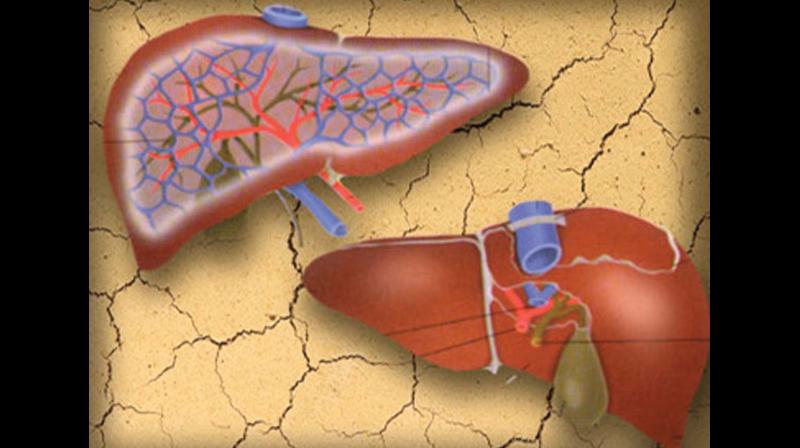 Many cases of liver failure are due to the lack of awareness and negligence in the initial stages. Many cases of liver failure are due to the lack of awareness and negligence in the initial stages.