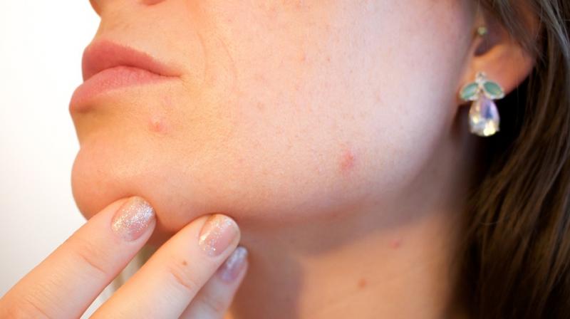 Acne stigma linked to lower overall quality of life. (Photo: Pixabay) Acne stigma linked to lower overall quality of life. (Photo: Pixabay)