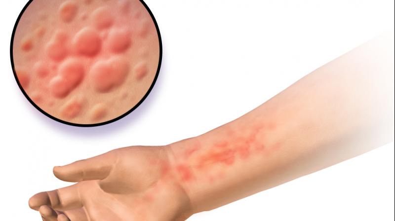 Eczema is a skin condtion characterised by inflammation and itching. (Photo; ANI) Eczema is a skin condtion characterised by inflammation and itching. (Photo; ANI)