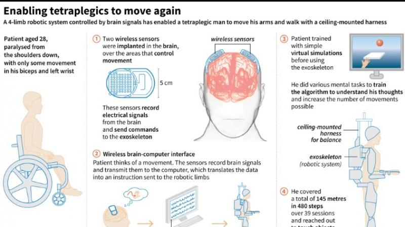 A French man paralysed in a night club accident can walk again thanks to a brain-controlled exoskeleton. (Photo: AFP) A French man paralysed in a night club accident can walk again thanks to a brain-controlled exoskeleton. (Photo: AFP)