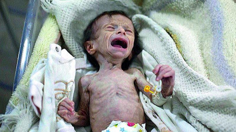 ahar Dofdaa, 34-month-old baby girl, was suffering from acute malnutrition. Her malnourished mother lost the ability to breastfeed. ahar Dofdaa, 34-month-old baby girl, was suffering from acute malnutrition. Her malnourished mother lost the ability to breastfeed.