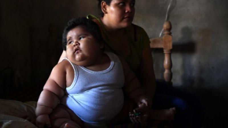 Obesity in childhood is associated with an increased risk of several disorders, including diabetes and cardiovascular disease. (Representational Photo: AFP) Obesity in childhood is associated with an increased risk of several disorders, including diabetes and cardiovascular disease. (Representational Photo: AFP)