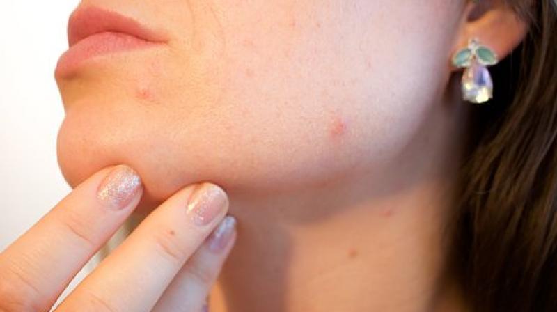 under the microscope the benefits of micro-needling can be observed, including a decrease in inflammatory markers released by cells. (Photo: Representational/Pixabay) under the microscope the benefits of micro-needling can be observed, including a decrease in inflammatory markers released by cells. (Photo: Representational/Pixabay)