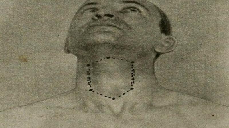 The researchers have created a skin-mountable sensor sticker that attaches firmly to the neck area . (Photo: ANI)