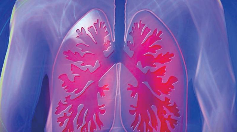 Smoking remains the most common cause of COPD that shows various symptoms such as breathlessness, cough and wheezing. Smoking remains the most common cause of COPD that shows various symptoms such as breathlessness, cough and wheezing.