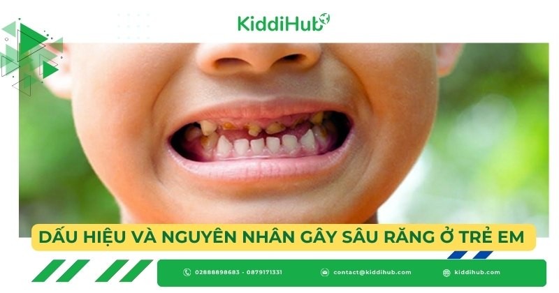 Dấu hiệu và nguyên nhân gây sâu răng ở trẻ em