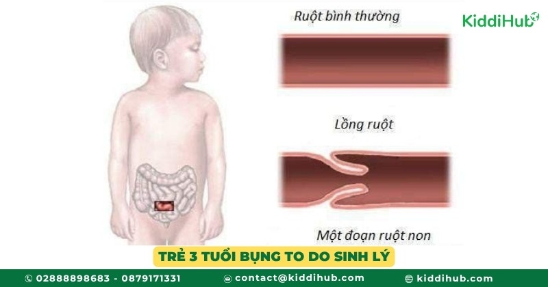 Trẻ 3 tuổi bụng to do sinh lý