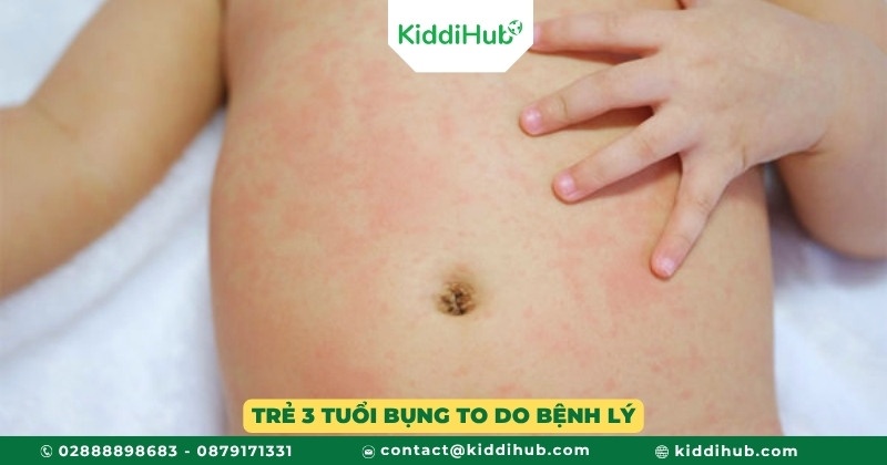 Trẻ 3 tuổi bụng to do bệnh lý