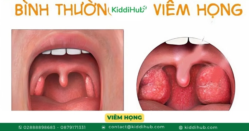 Viêm họng