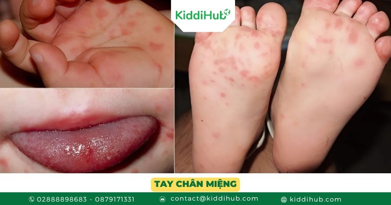 Tay chân miệng