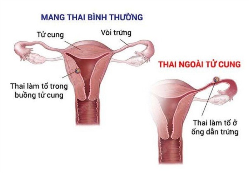 dau-hieu-mang-thai-ngoai-tu-cung