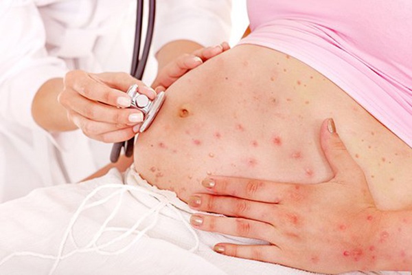 me-bau-bi-rubella