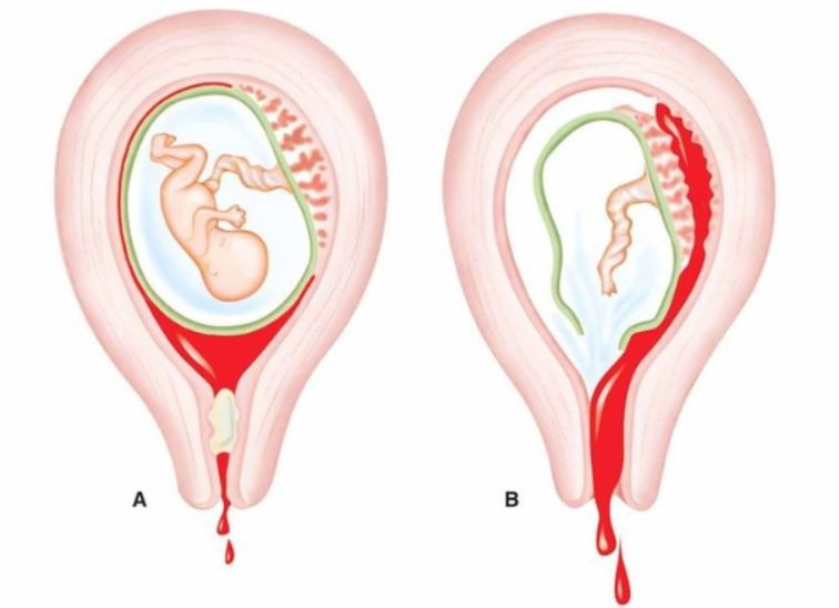 dau-hieu-mang-thai-lan-2-sau-sinh-mo