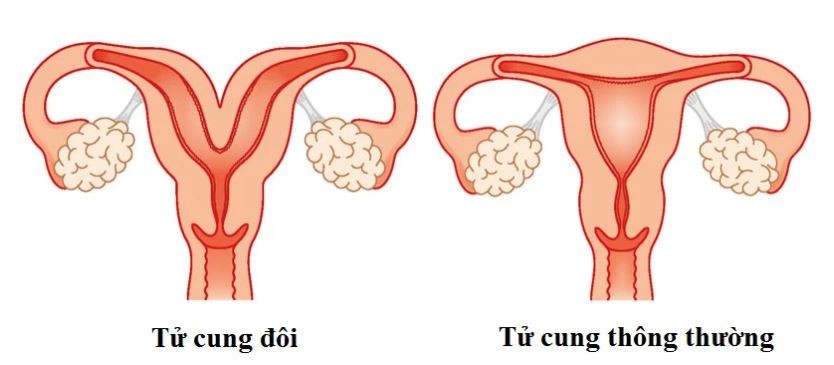 phau-thuat-tu-cung-doi