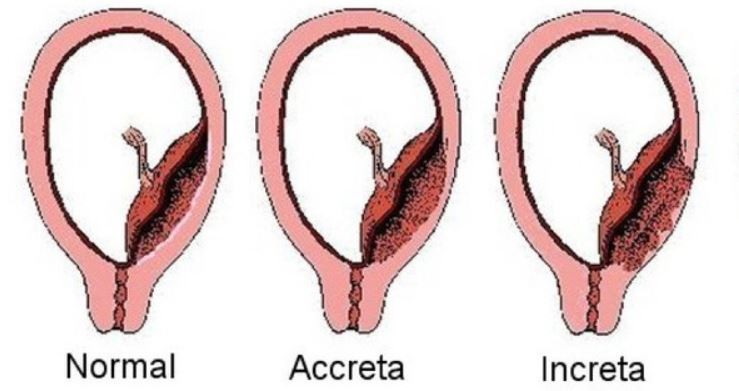 dau-hieu-mang-thai-lan-2-sau-sinh-mo