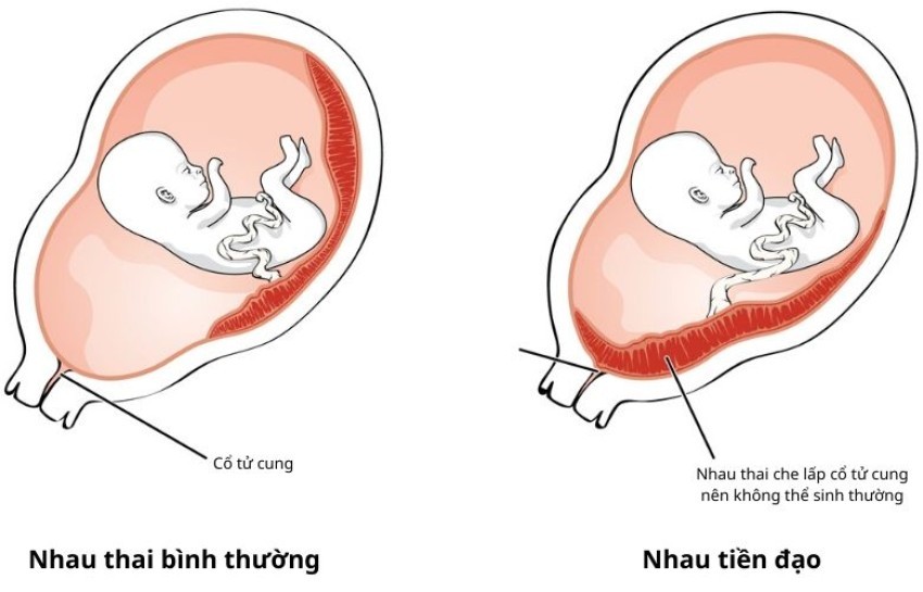 bung-bau-co-bop-duoc-khong