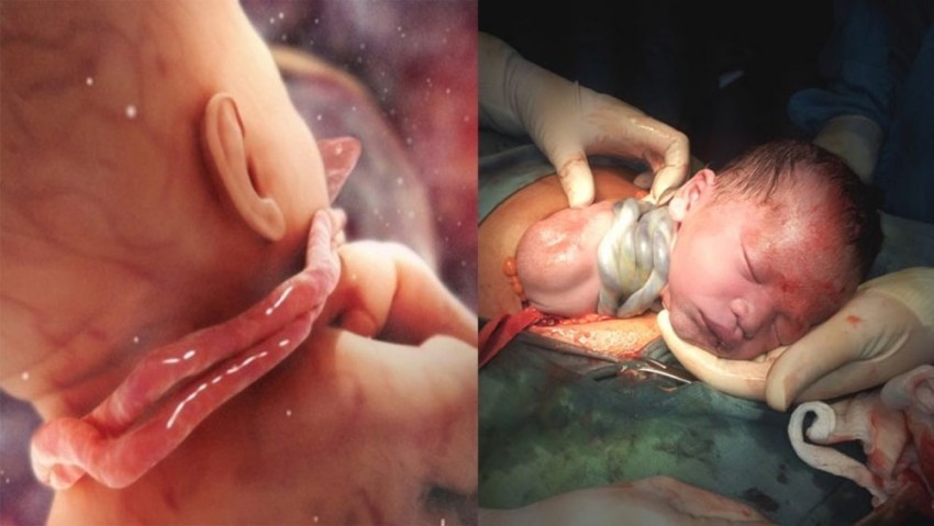 bung-bau-co-bop-duoc-khong