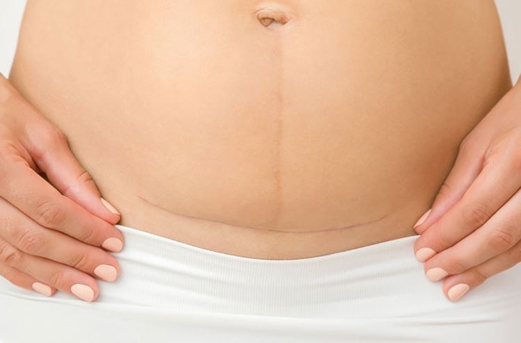 dau-hieu-mang-thai-lan-2-sau-sinh-mo