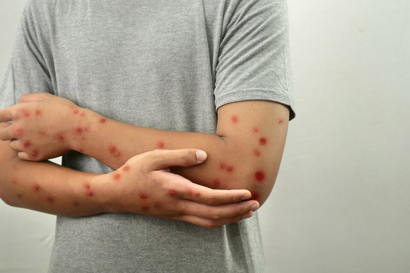 measles-virus