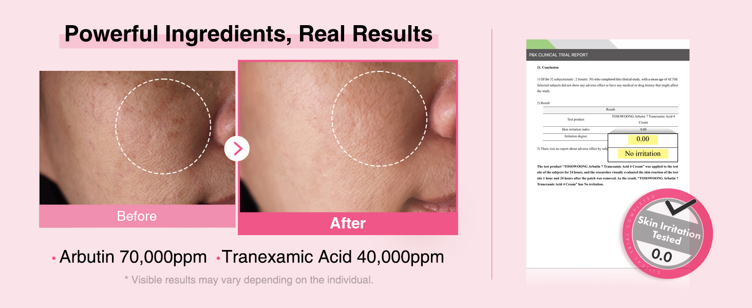 Arbutin 7% + Tranexamic Acid 4% Cream for detail 2