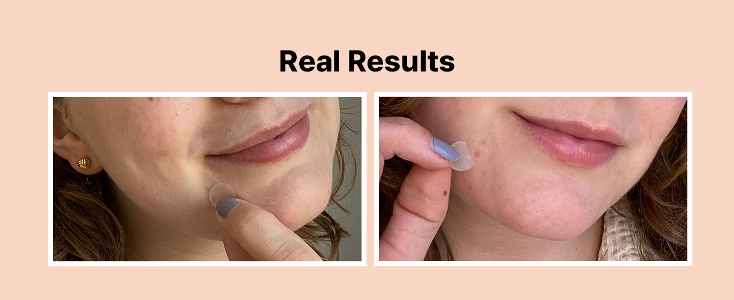 Acne Pimple Patches Absorbing Hydrocolloid Spot detail 3