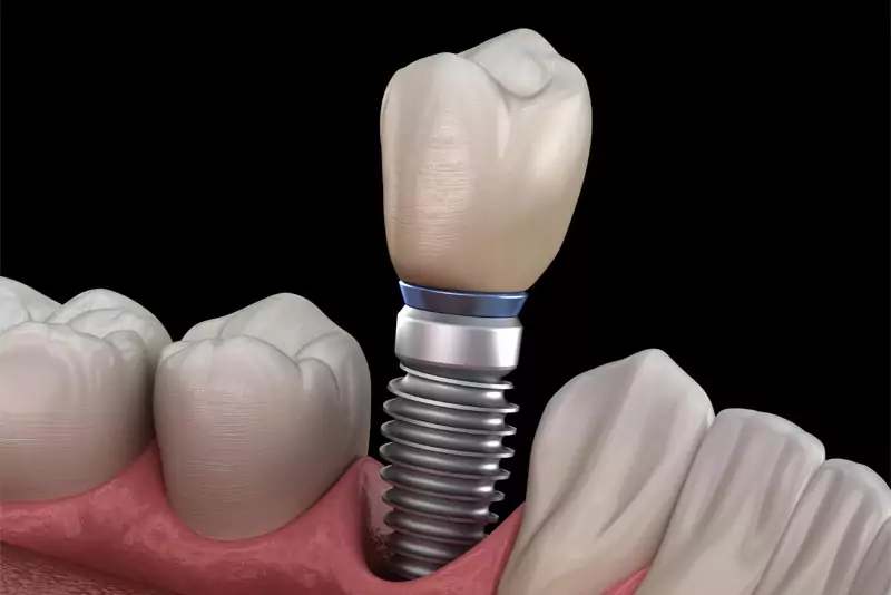 single dental implant model.jpg