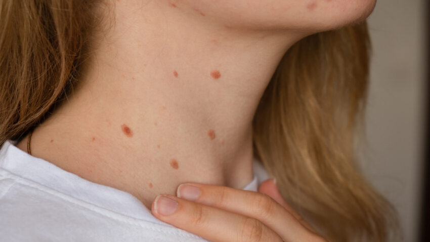 Are Skin Tags Contagious
