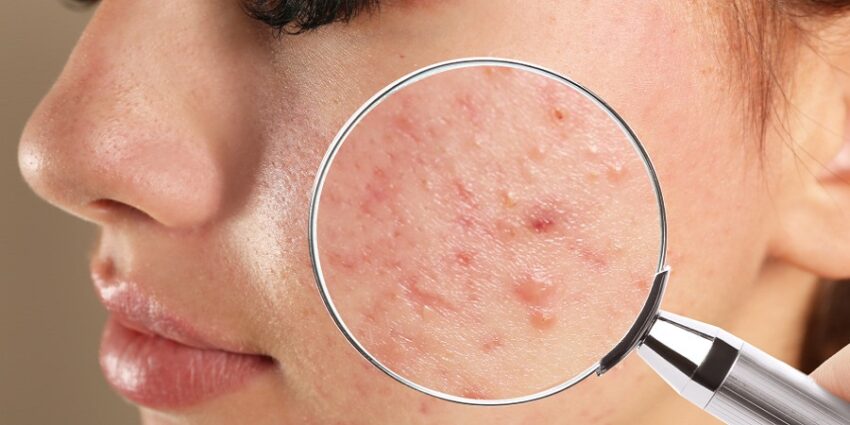 Acne Treatment in Saudi Arabia