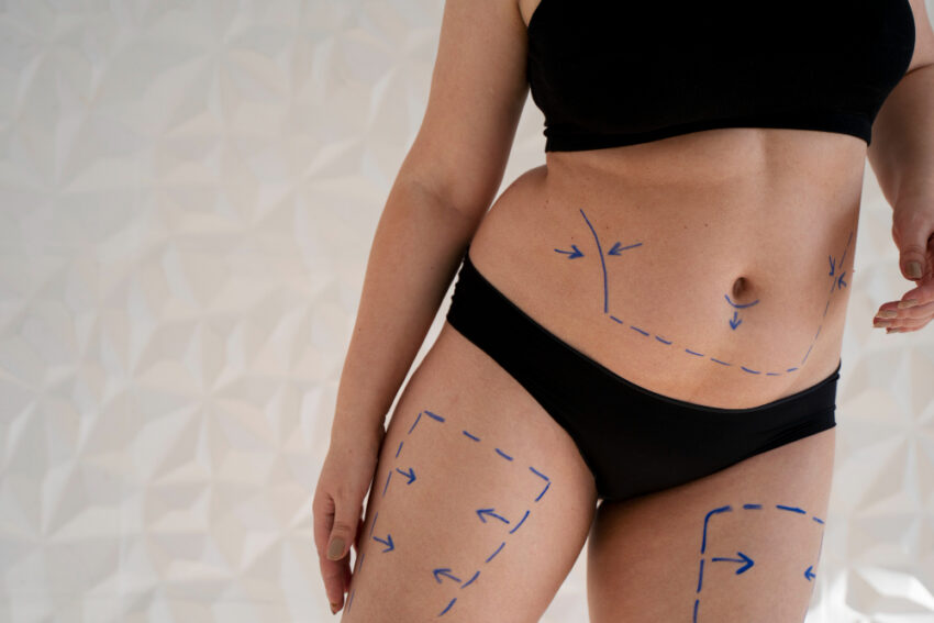 Liposuction in Dubai