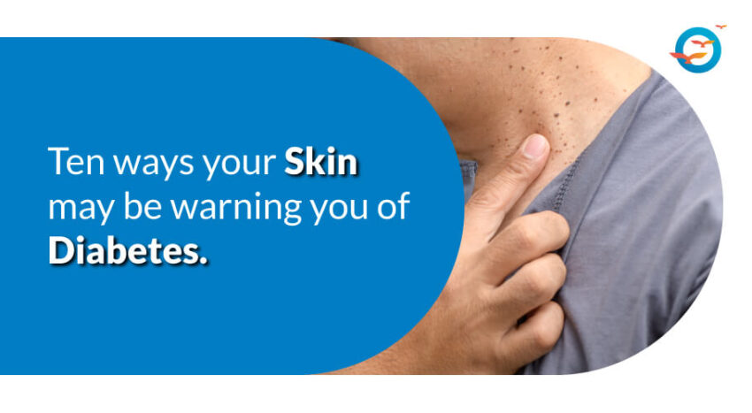 Skin warning of diabetes