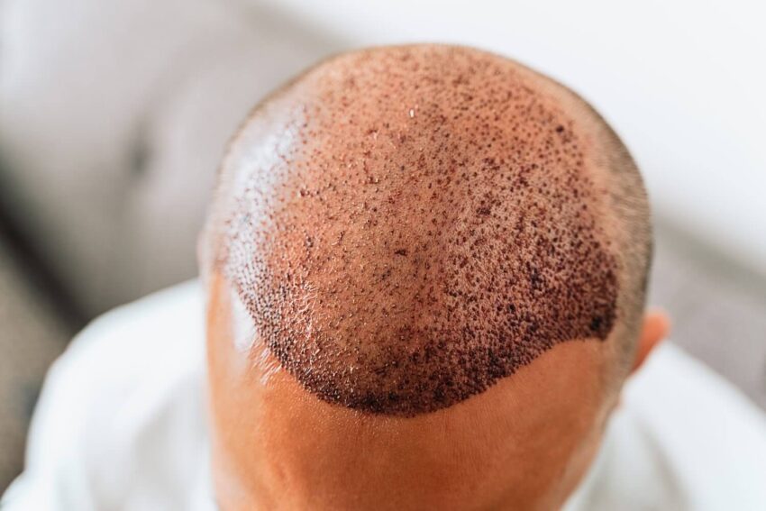 Hair transplant