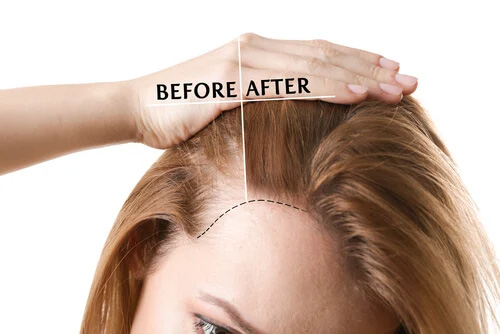 FUE Direct Hair Transplant DRHC Dubai Hair Transplant Clinic copy