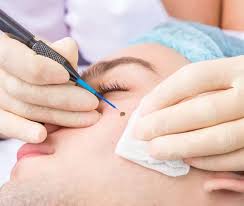 Skin Tags Removal in Dubai