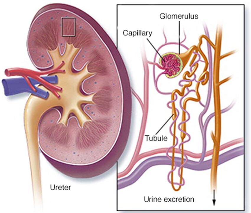 Congenital Nephrotic Syndrome1
