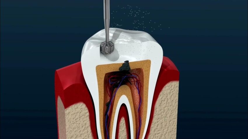 Root canal Bakersfield image 2