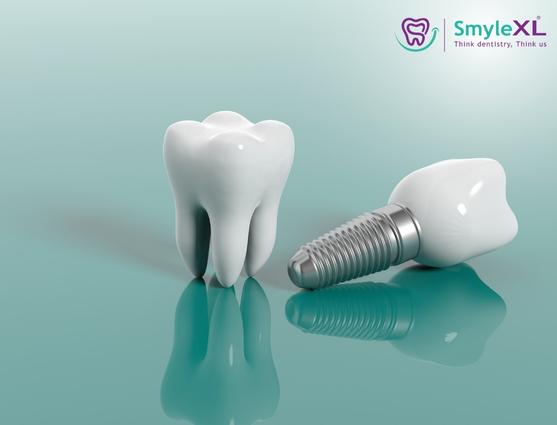 Dental Implant