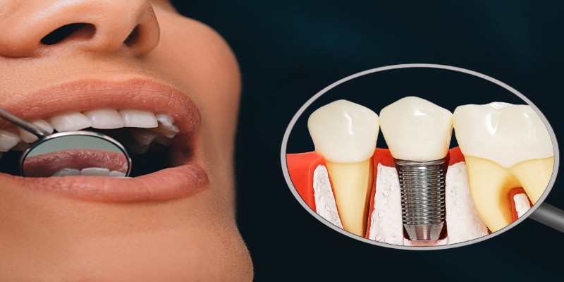 Dental Implant resize
