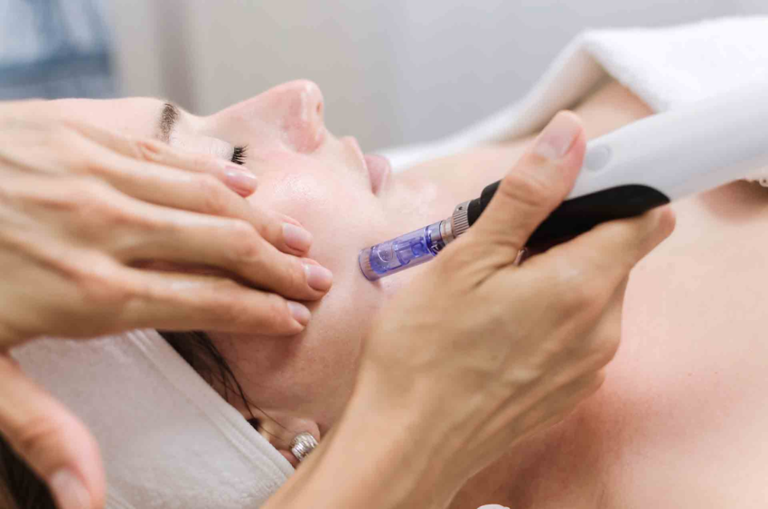 Microneedling Christiana