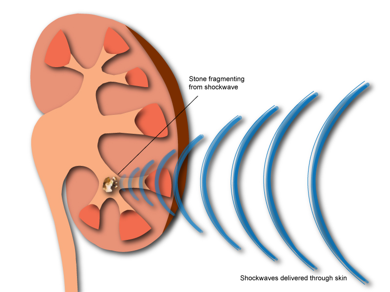 Shock Wave Lithotripsy