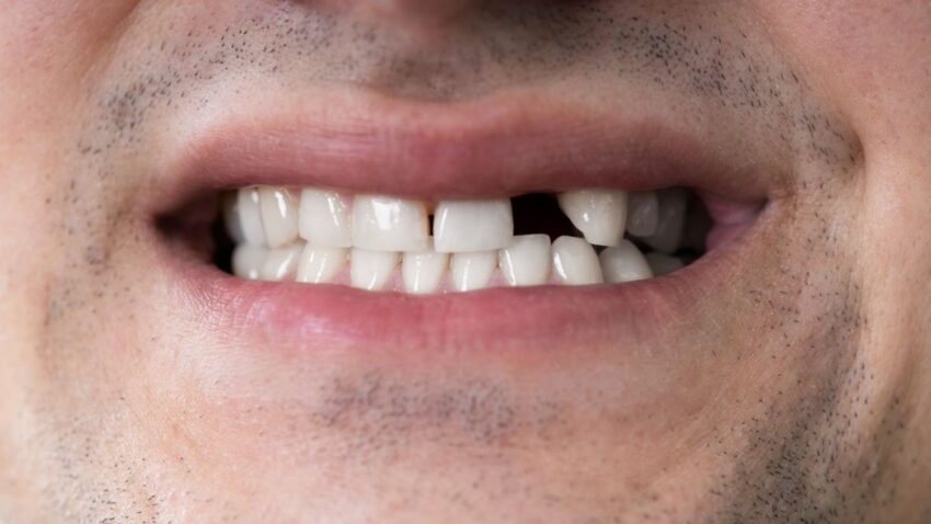 Missing Tooth Treatment1