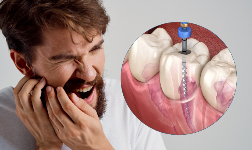 Root Canal