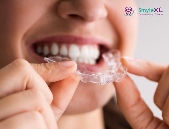 Invisible Braces Treatment in Dwaraka Nagar 1